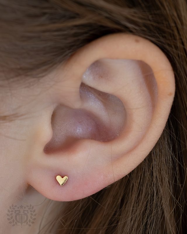 Keloids & Scarring Risk In Kids — Apollo Studio Los Angeles