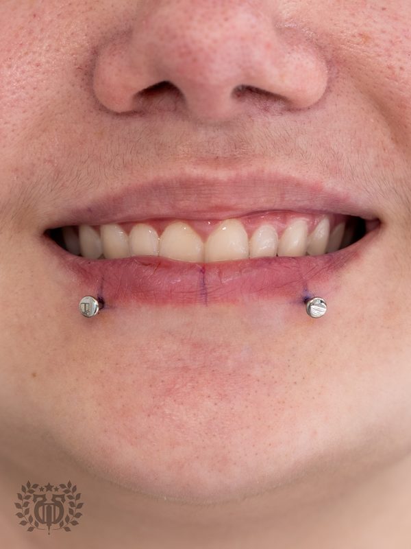 Lip piercing at Apollo — Apollo Tattoo & Piercing Studio 4