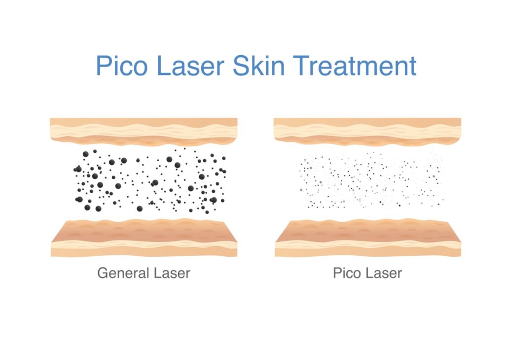 Illustration of tattoo pigment breakdown with pico laser