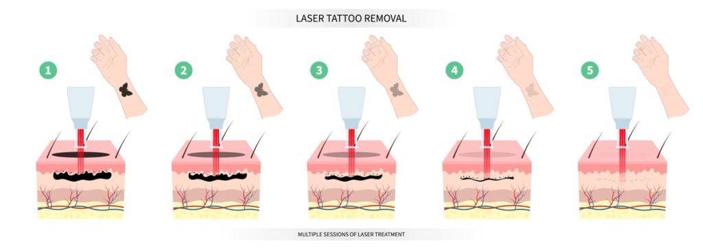 Illustration showing progress removing a small wrist tattoo over the course of 5 removal sessions, demonstrating multiple sessions as a cost factor