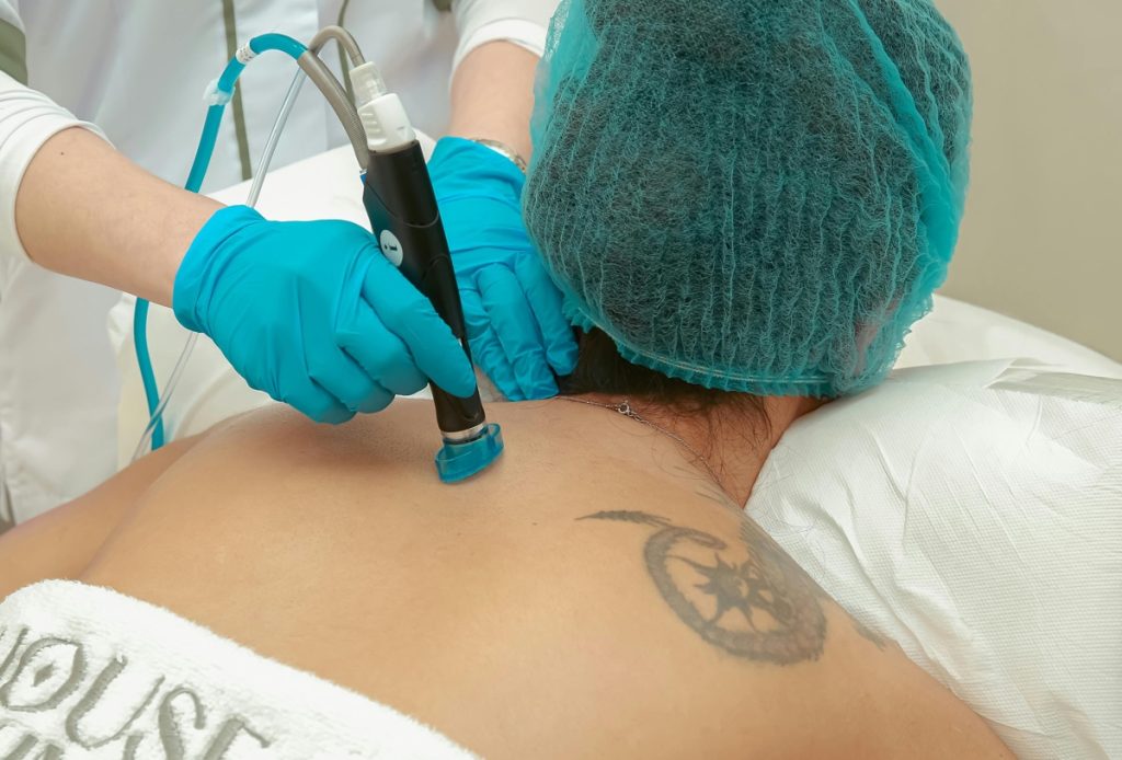 Laser removal treatment in progress on a shoulder tattoo