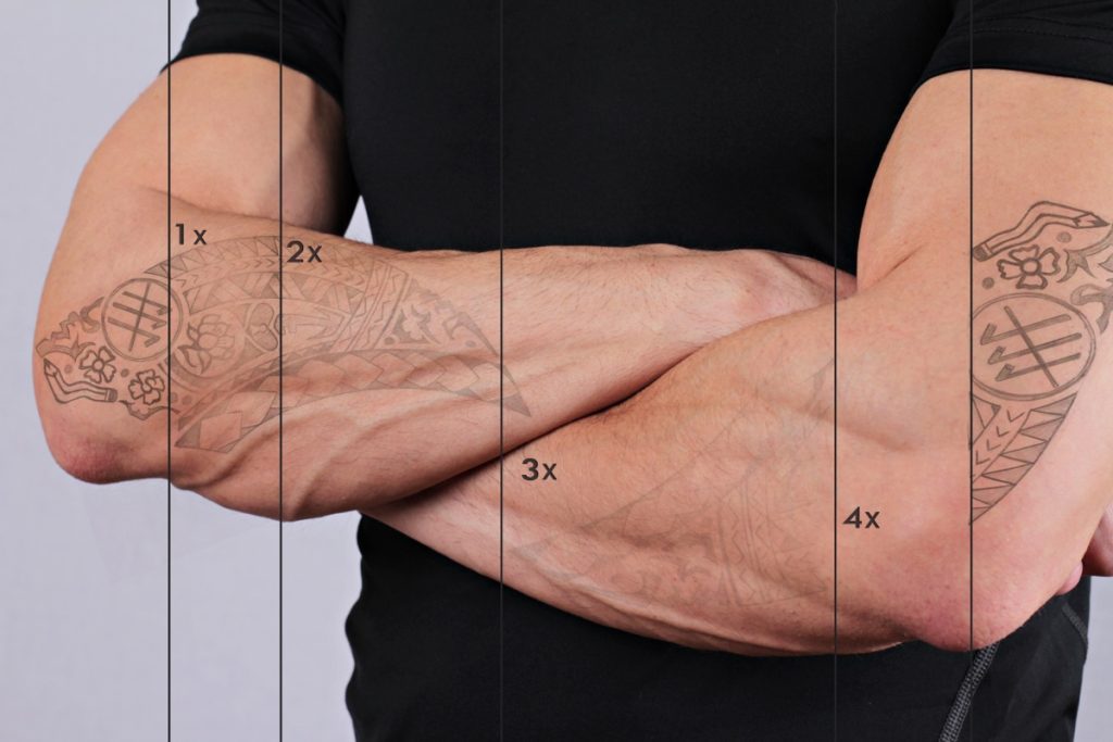 Progress timeline showing a tattoo fading over the course of 4 removal sessions